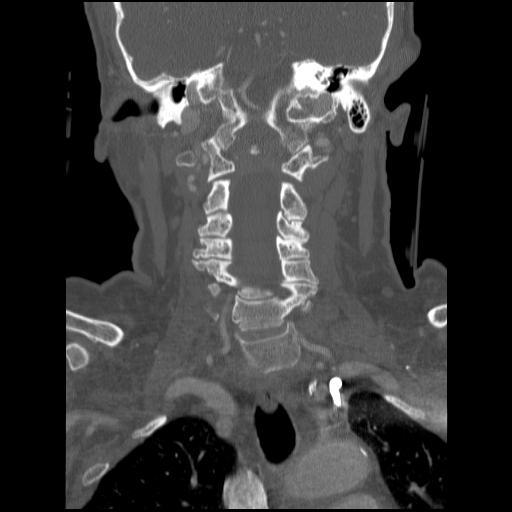 File:C1 anterior arch (plough) fracture - type 1 (Radiopaedia 76181-87720 Coronal bone window 50).jpg