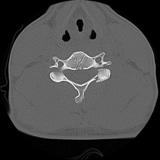 File:C5 facet fracture (Radiopaedia 58374-65499 Axial bone window 54).jpg