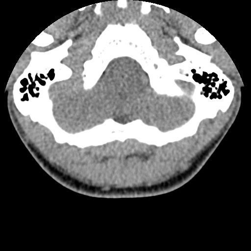C5 facet fracture (Radiopaedia 58374-65499 Axial non-contrast 3).jpg