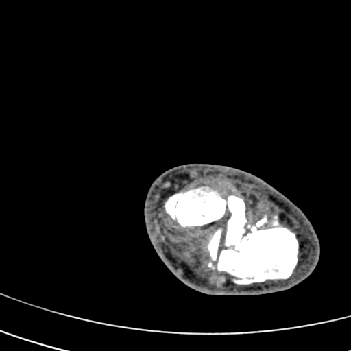 File:Calcaneal fracture - Sanders type 4 (Radiopaedia 90179-107370 Axial non-contrast 22).jpg