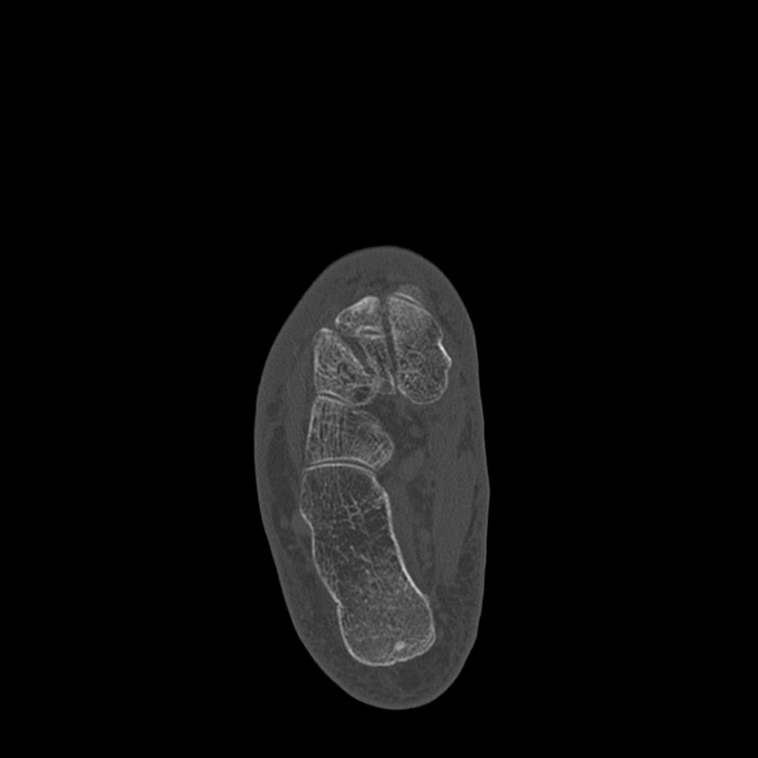 Calcaneal tuberosity avulsion fracture (Radiopaedia 22649-22668 Axial bone window 30).jpg