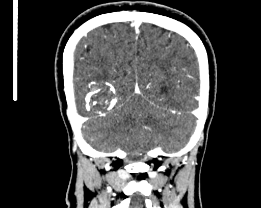 File:Calcified cerebral hydatid cyst (Radiopaedia 65603-74717 C 58).jpg