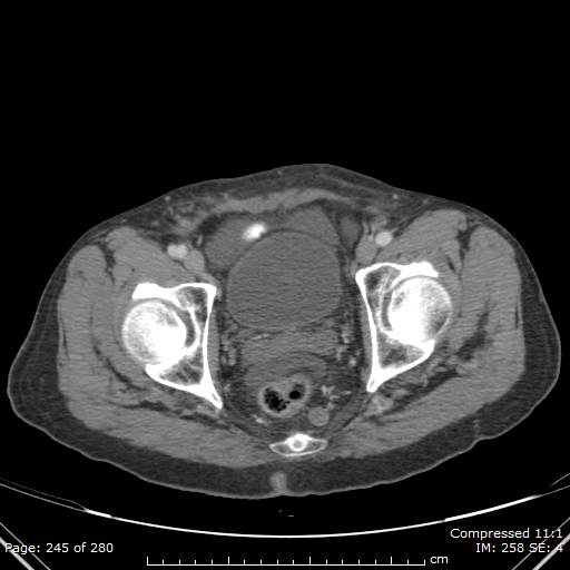 Calcified liver metastases (Radiopaedia 44699-48470 B 58).jpg