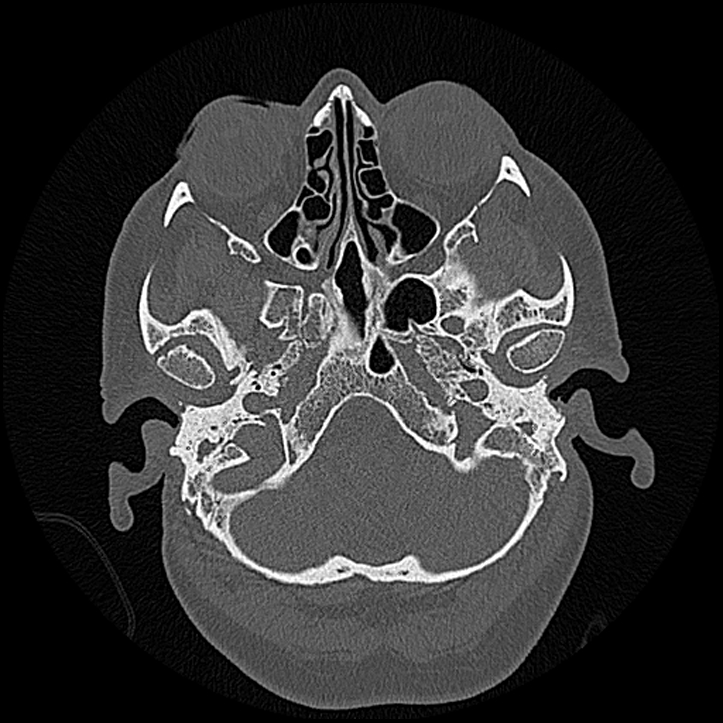 Canal up mastoidectomy (Radiopaedia 78108-90638 Axial bone window 37).jpg