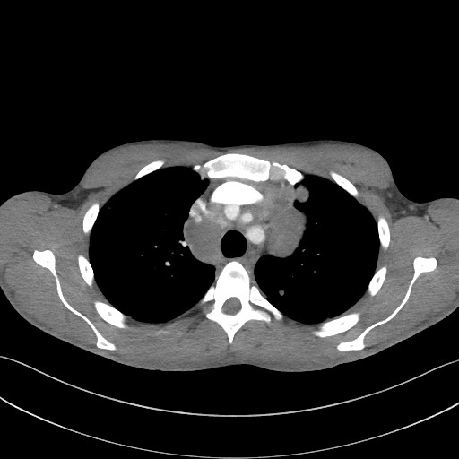Cannonball metastases - testicular choriocarcinoma (Radiopaedia 84510-99891 B 38).jpg