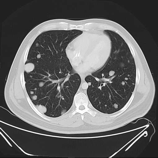 File:Cannonball pulmonary metastases (Radiopaedia 67684-77101 Axial lung window 16).jpg