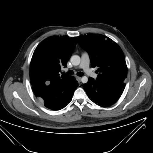 File:Cannonball pulmonary metastases (Radiopaedia 67684-77101 D 116).jpg