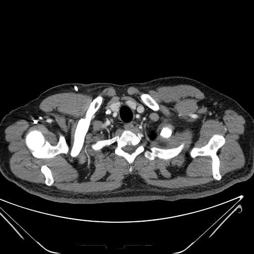 File:Cannonball pulmonary metastases (Radiopaedia 67684-77101 D 18).jpg