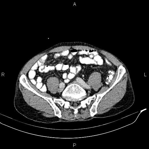 Caput medusae sign - portal hypertension (Radiopaedia 64007-72759 A 70).jpg