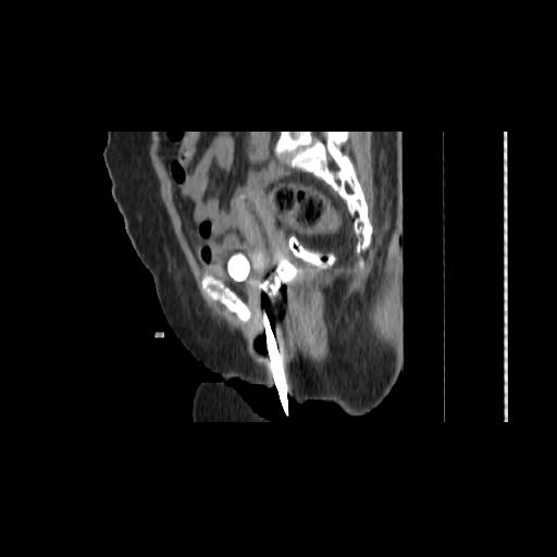 File:Carcinoma cervix- brachytherapy applicator (Radiopaedia 33135-34173 D 78).jpg