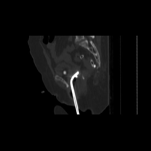 Carcinoma cervix- brachytherapy applicator (Radiopaedia 33135-34173 Sagittal bone window 107).jpg