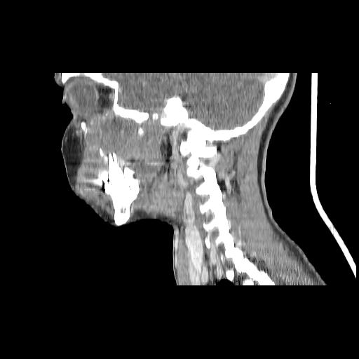 Carcinoma of the maxillary antrum (Radiopaedia 53805-59888 Sagittal C+ delayed 68).jpg