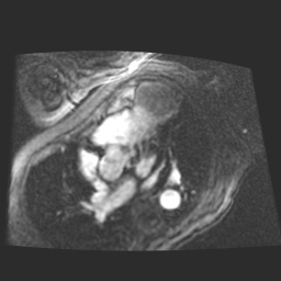 File:Cardiac fibroma (Radiopaedia 38974-41150 4 chamber FGRET 13).jpg