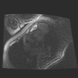 File:Cardiac fibroma (Radiopaedia 38974-41150 4 chamber FGRET 22).jpg