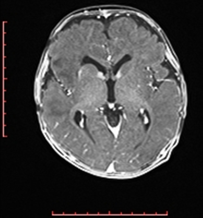 Cardiac rhabdomyoma - tuberous sclerosis (Radiopaedia 70089-80114 Axial T1 C+ fat sat 41).jpg