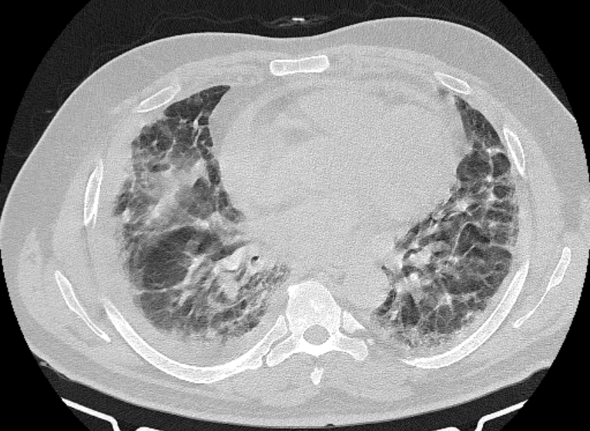 Cardiogenic pulmonary edema (Radiopaedia 68180-77678 Axial lung window 58).jpg