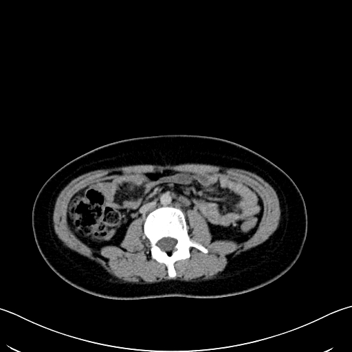 Caroli disease with medullary sponge kidney (Radiopaedia 82622-96804 C 38).jpg