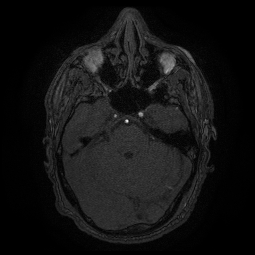 Carotid arterial dissection with acute cerebral infarction (Radiopaedia 26636-26784 MRA 122).jpg