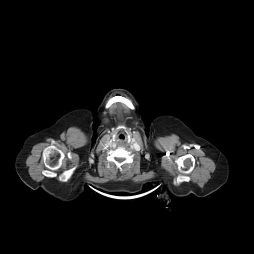 File:Carotid body tumor (Radiopaedia 21021-20948 B 17).jpg