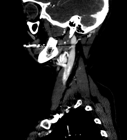 File:Carotid body tumor (Radiopaedia 39845-42300 D 4).jpg