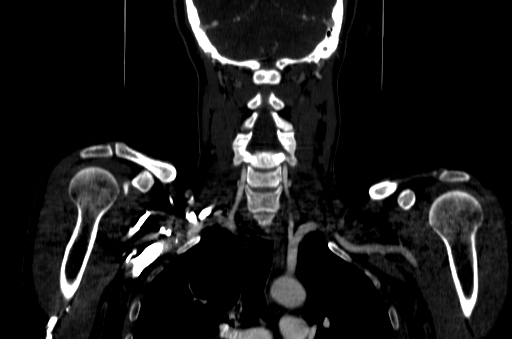 File:Carotid bulb pseudoaneurysm (Radiopaedia 57670-64616 D 60).jpg