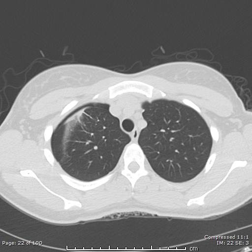 File:Catamenial pneumothorax (Radiopaedia 54382-60600 Axial non-contrast 22).jpg