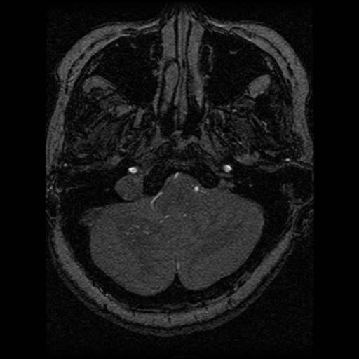 Cavernoma, DVA and right ICA aneurysm (Radiopaedia 33890-35072 E 96).png