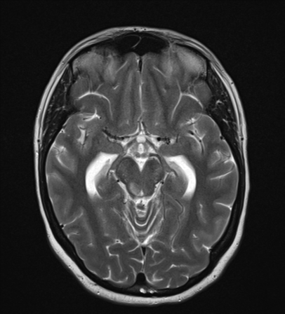 File:Cavernoma with bleed - midbrain (Radiopaedia 54546-60774 Axial T2 11).png