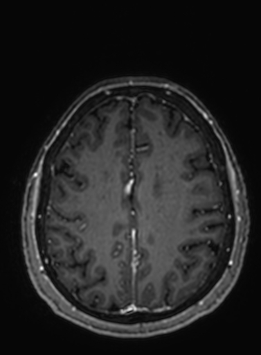Cavernous hemangioma of the cerebellar falx (Radiopaedia 73025-83724 Axial T1 C+ 102).jpg