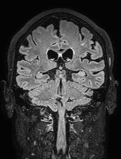 Cavernous hemangioma of the cerebellar falx (Radiopaedia 73025-83724 Coronal FLAIR 216).jpg