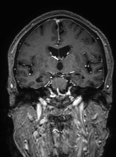 Cavernous hemangioma of the cerebellar falx (Radiopaedia 73025-83724 Coronal T1 C+ 186).jpg