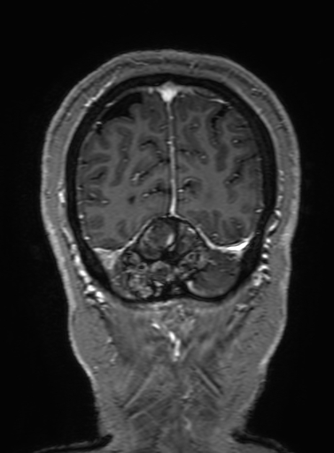 Cavernous hemangioma of the cerebellar falx (Radiopaedia 73025-83724 Coronal T1 C+ 327).jpg