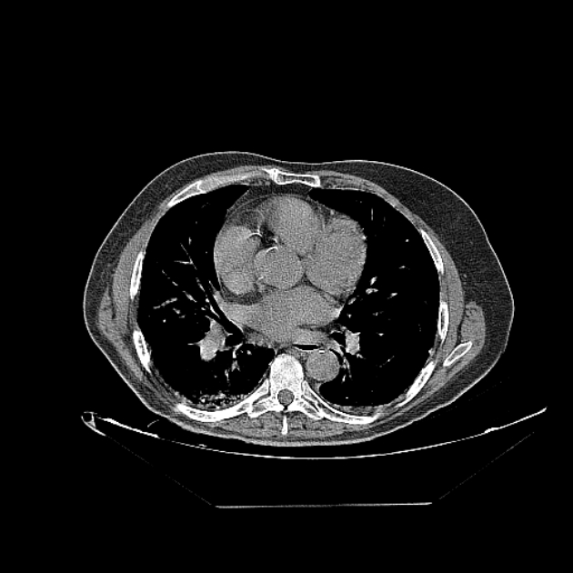 Cavitating bronchogenic carcinoma (Radiopaedia 44489-48162 Axial non-contrast 49).jpg