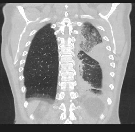 File:Cavitating pneumonia complicated by pneumothorax (Radiopaedia 48149-52994 Coronal lung window 46).png