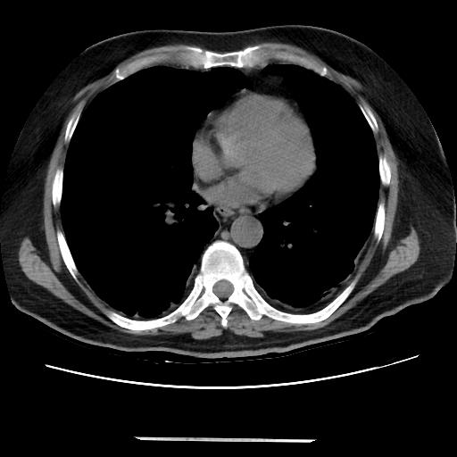 Cavitating pulmonary metastases (Radiopaedia 89545-106544 Axial non-contrast 35).jpg