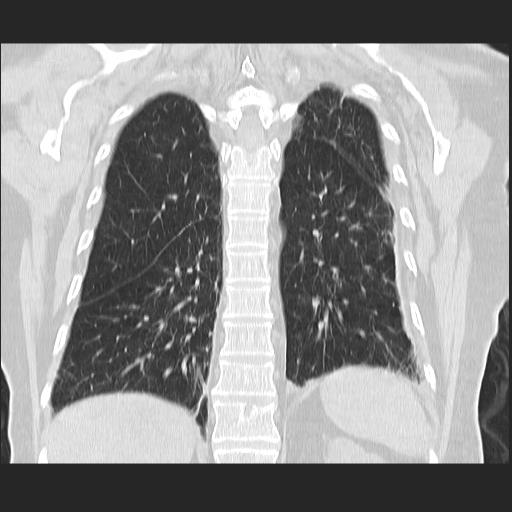 File:Cavitating pulmonary metastases (Radiopaedia 89545-106544 Coronal lung window 33).jpg