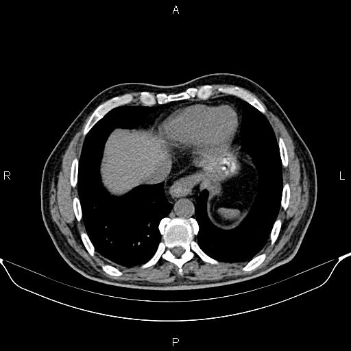 Cecal adenocarcinoma (Radiopaedia 85324-100916 Axial non-contrast 8).jpg