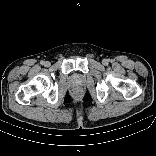 File:Cecal cancer with appendiceal mucocele (Radiopaedia 91080-108651 Axial C+ delayed 86).jpg