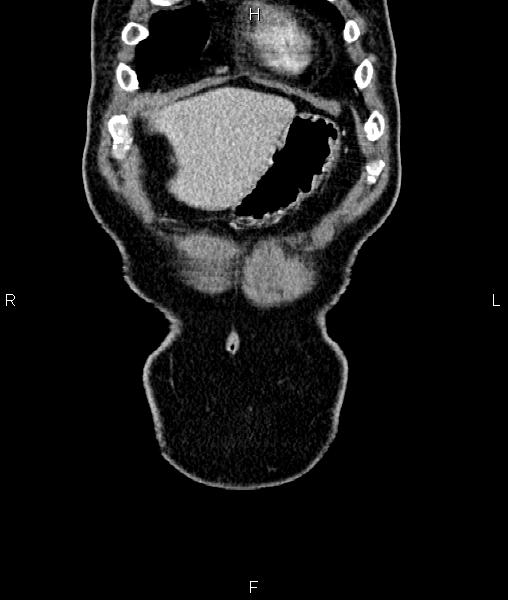Cecal cancer with appendiceal mucocele (Radiopaedia 91080-108651 D 6).jpg