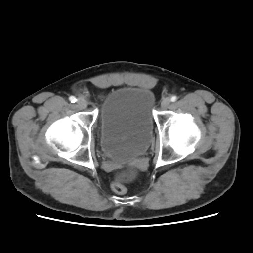 Cecal mass causing appendicitis (Radiopaedia 59207-66531 A 82).jpg