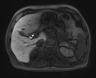 Cecal mass causing appendicitis (Radiopaedia 59207-66532 K 39).jpg