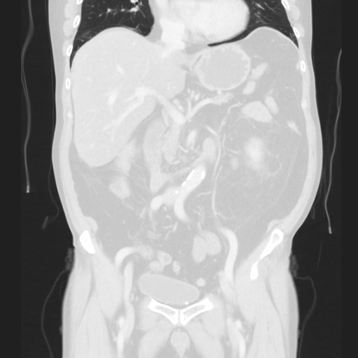 Cecal volvulus (Radiopaedia 75378-86620 Coronal lung window 71).jpg