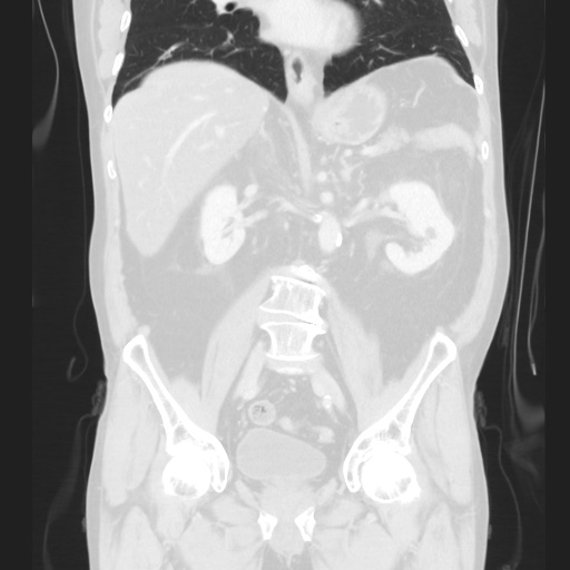 Cecal volvulus (Radiopaedia 75378-86620 Coronal lung window 82).jpg