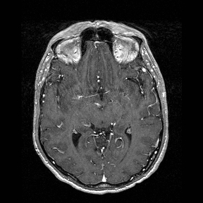 File:Central-variant posterior reversible encephalopathy syndrome (PRES) (Radiopaedia 43880-47358 Axial T1 C+ 71).jpg