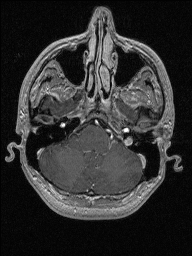 Central neurocytoma (Radiopaedia 56690-63469 Axial T1 C+ 36).jpg