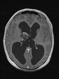 Central neurocytoma (Radiopaedia 56690-63469 Axial T1 C+ 84).jpg