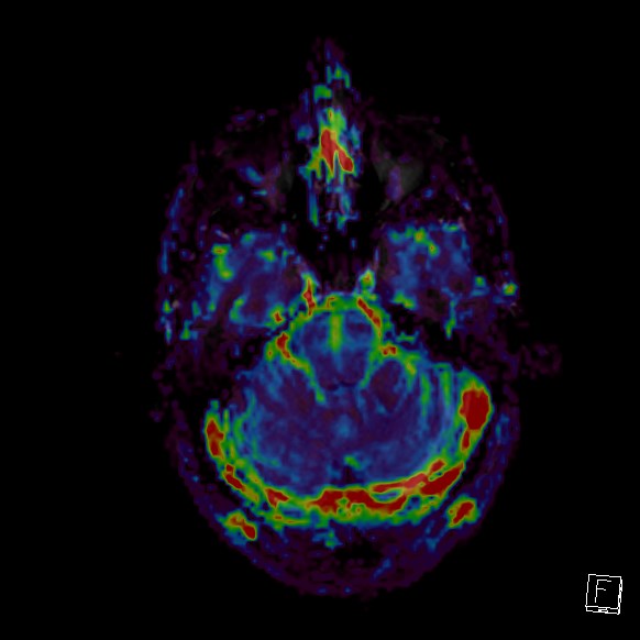 Central neurocytoma (Radiopaedia 84497-99872 Axial Perfusion 239).jpg