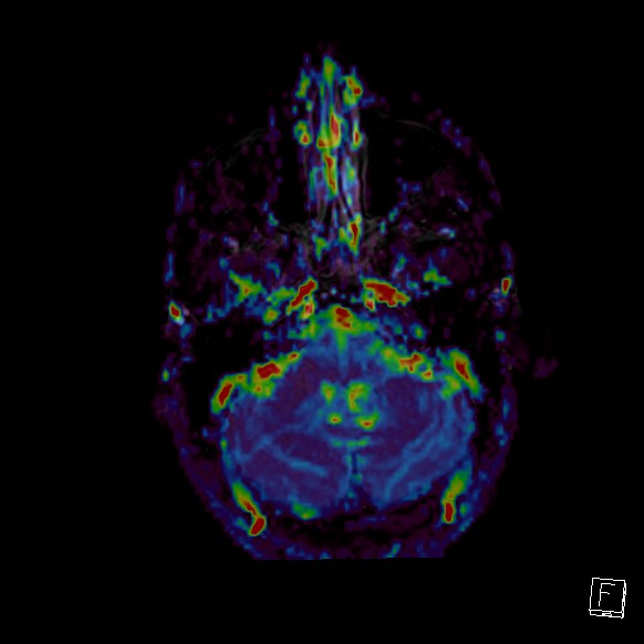 Central neurocytoma (Radiopaedia 84497-99872 Axial Perfusion 262).jpg
