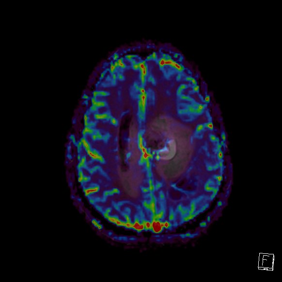 Central neurocytoma (Radiopaedia 84497-99872 Axial Perfusion 93).jpg
