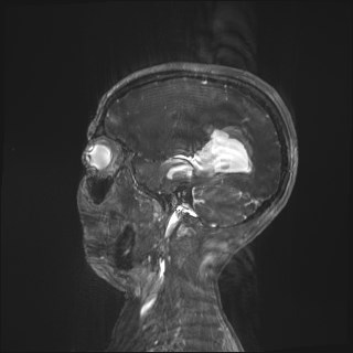 Central neurocytoma (Radiopaedia 84497-99872 Sagittal CISS 4).jpg